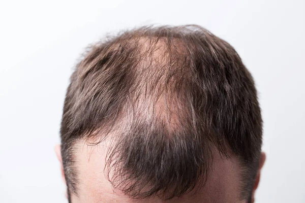 Close-up balding head of a young man on a white isolated background. — Stock Photo, Image
