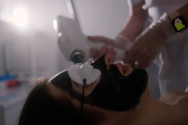 Koruyucu gözlüklü ve cildine yeşil lazer ışığı takılı karbon lazer tedavisi gören bir kadının yakın çekimi. Derin temizlik ve gençleştirme için modern bir cilt bakımı..