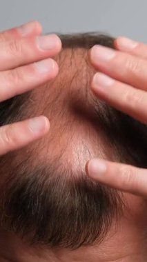 Kel ve ince saçlı, kafa derisi tutan, saç dökülmesi, saç dökülmesi, saç bakımı ve saç bakımı olan bir adamın yakın çekimi. Dikey video.