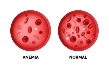 Beyaz arka plan üzerinde izole anemi Infographic görüntüsü. Gerçekçi vektör 3d resim kırmızı kan hücreleri veya insan kan hemoglobin miktarı