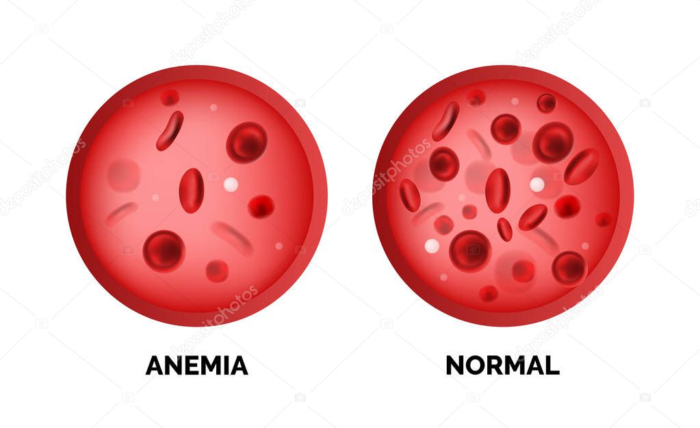 Infographic image of anemia isolated on white background. Realistic vector 3d picture of red blood cells or hemoglobin amount in human blood