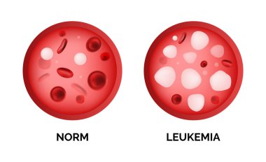 Infographic image of leukemia, lukemia or leukaemia isolated on white background. Realistic vector 3d picture of blood cells in human vein clipart