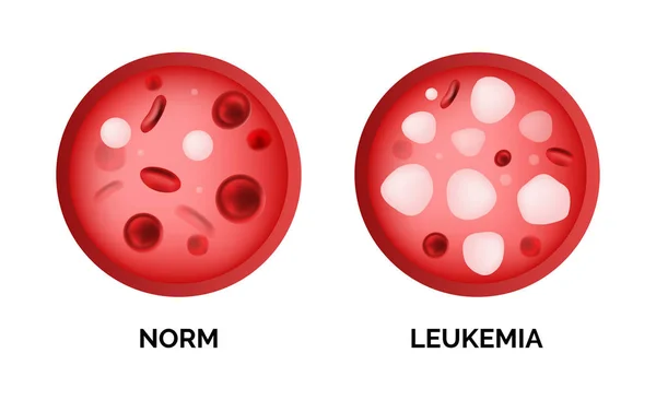 Imagen Infográfica Leucemia Lukemia Leucemia Aislada Sobre Fondo Blanco Vector — Vector de stock