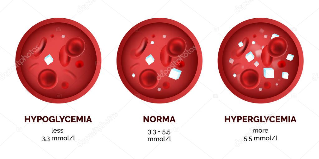 Infographic image of blood sugar levels isolated on white background. Realistic vector 3d picture of human hypoglycemia and hyperglycemia