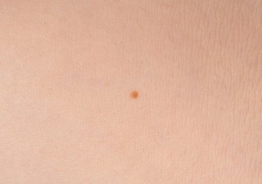 Deri benini yakından çek. İnsan doğum lekesi, iyi huylu nevus veya köstebek makro dokusu, potansiyel melanom veya dermatoloji tasarımı için kanser