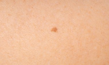 Deri benini yakından çek. İnsan doğum lekesi, iyi huylu nevus veya köstebek makro dokusu, potansiyel melanom veya dermatoloji tasarımı için kanser