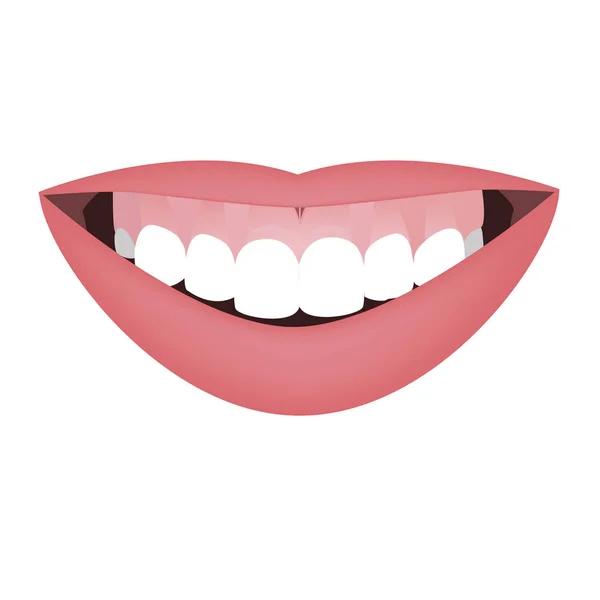 Bouche avec une morsure distale et une ligne de sourire élevée ou un sourire gommeux avant le traitement orthotrope ou orthotrope. Illustration vectorielle — Image vectorielle