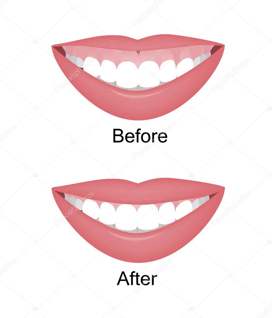 Mouth with a high smile line or gummy smile before and after the orthotropics, orthotropics or botox injections correction. Vector illustration