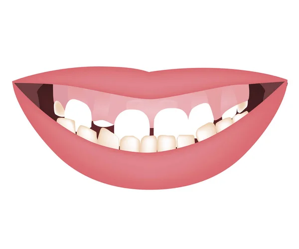 La boca de los niños con una mandíbula demasiado grande y una alta línea de sonrisa o una sonrisa gomosa antes del tratamiento ortotrópico o ortotrópico. Oclusión dental submordida — Archivo Imágenes Vectoriales