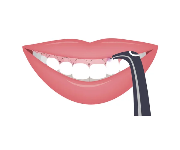 Correction laser d'une ligne de sourire haute ou d'un sourire gommeux. Illustration vectorielle — Image vectorielle