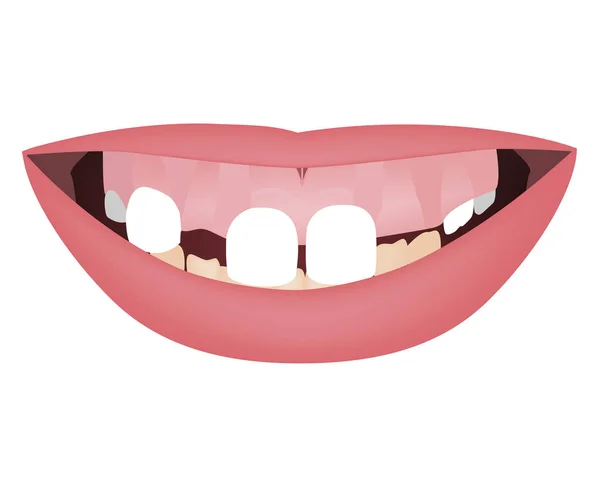 Mascelle per bambini con sorriso gommoso, denti inferiori storti e morso distale prima del trattamento ortopedico o ortopedico. Illustrazione vettoriale — Vettoriale Stock