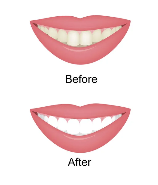 Sbiancamento dei denti prima e dopo. Illustrazione vettoriale — Vettoriale Stock