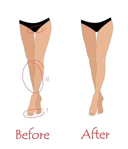 Vrouw epilatie of ontharing concept - benen en bikini zone voor en na ongewenste ontharing. Vector — Stockvector