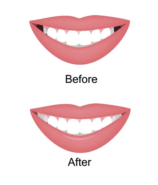 The smile with large and dark buccal corridor before and after correction. Vector illustration. Dark spaces at the edge of the smile problem treatment — Stock Vector