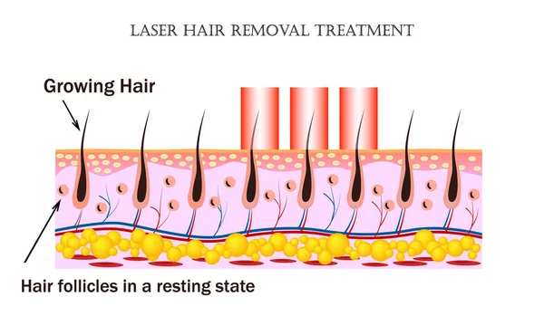 Tratamento da remoção do cabelo do laser. Procedimento provoca danos ao folículo piloso sem ferir o tecido da pele e folículos pilosos no estado de repouso . — Vetor de Stock