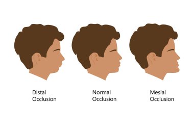Distal, Normal ve Mesial ısırık profili olan adam, vektör çizimi. Ortodontik tedaviden önce ve sonra dişler ve dişler. Maloksiyonlu insan, diş teli konseptine göre ısırık düzeltmesi.