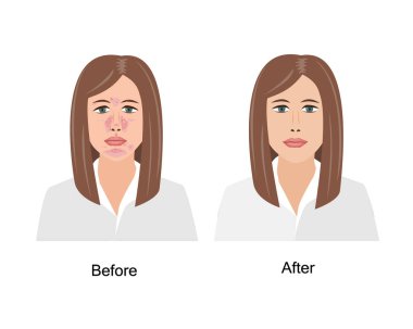 Woman Suffering from Seborrheic Dermatitis before and after medical treatment. Vector illustration. Adult or teenager face with skin problems isolated white background clipart