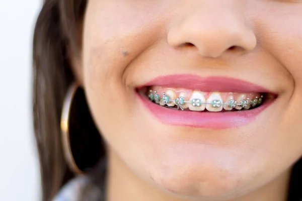 Mouth Smiling Girl Holding Dental Appliance — Stock Photo, Image