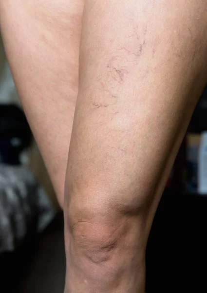 Ugly small veins are visible on the female leg. Health.