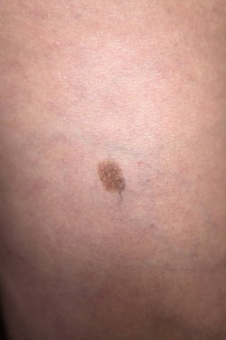 İnsan derisi üzerinde küçük bir doğum izi. Yakın çekim.