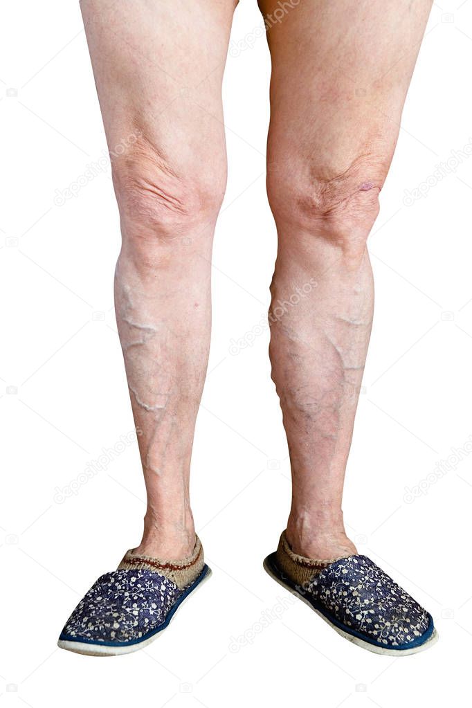 Ugly sick legs of an old woman on a white background. Phlebeurysm.
