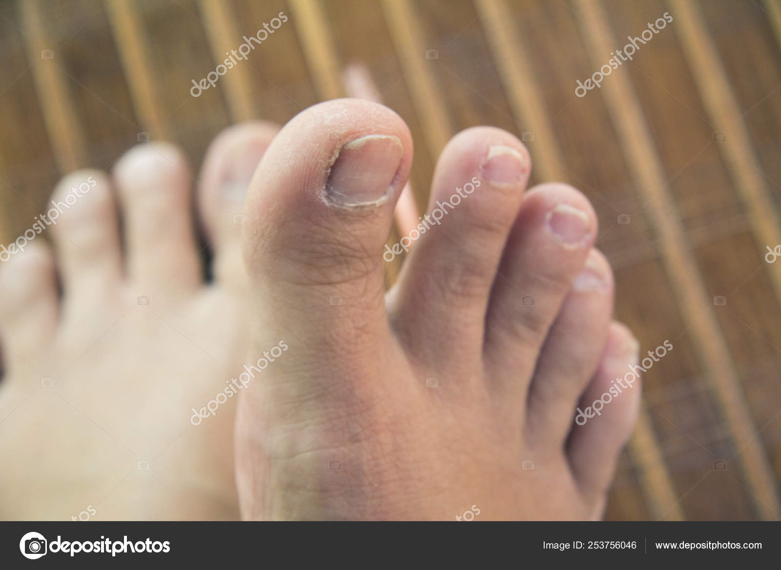 Discover 150+ ugly feet in sandals latest vietkidsiq.edu.vn