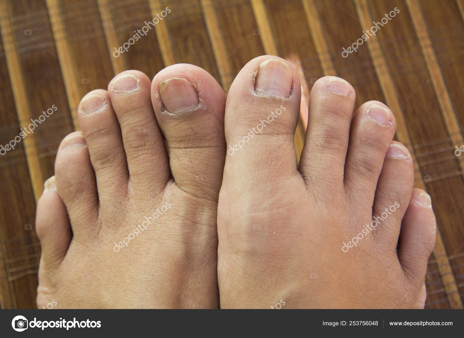 Ugly feet Stock Photo by ©oathka 253756048