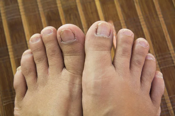 Lelijke voeten — Stockfoto
