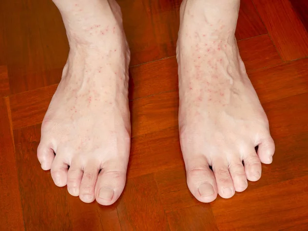 Itchy Skin Rash Woman Feet Caused Allergic Eczema Health Skin — Stock Photo, Image