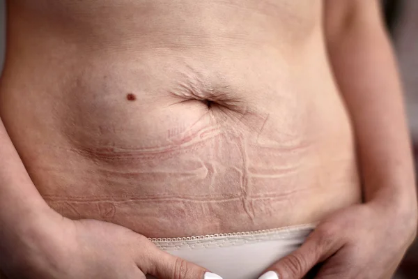 kadının karın çatlakları ve sarkık deri. Cilt usulsüzlük kırışık cilt karın izleri. dar kot pantolon, Pantolon sonuçları. insan derisi kusurlu doku