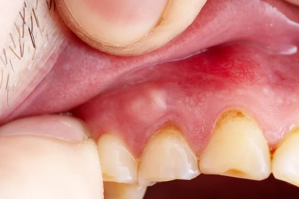 Inflammation of the gums abscess closeup, teeth in poor conditio — Stock Photo, Image