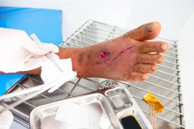 hastalar ayak yarası closeup enfeksiyon . 