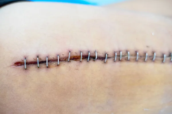 Sutures Plaies Dans Corps Des Patients Hôpital Blessure Cousue Avec Images De Stock Libres De Droits