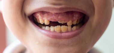 Küçük çocuk göstermek bir kırık ve çürük dişler ile kırık teeth.boy