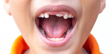 Küçük çocuk göstermek bir kırık ve çürük dişler ile kırık teeth.boy