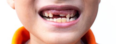 Küçük çocuk göstermek bir kırık ve çürük dişler ile kırık teeth.boy