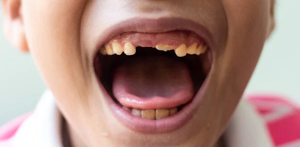 Μικρό Αγόρι Δείχνουν Σπασμένα Teeth Boy Ένα Σπασμένο Και Σάπια — Φωτογραφία Αρχείου