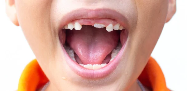 Little Boy Show Broken Teeth Boy Broken Rotten Teeth — Stock Photo, Image