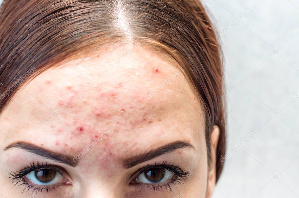 portrait of a young woman with pimples, pigmentation spots and post acne