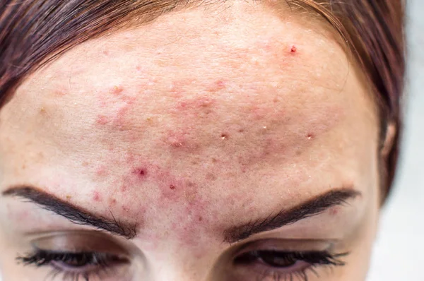 bir genç kız closeup yüzünde sivilce