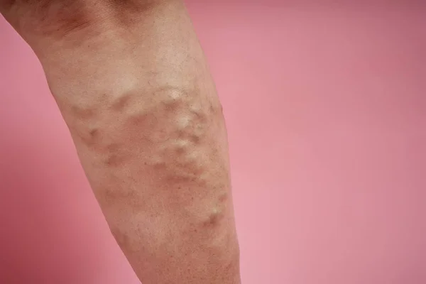 Legs of senior woman with varicose veins on coral background. — Stock Photo, Image