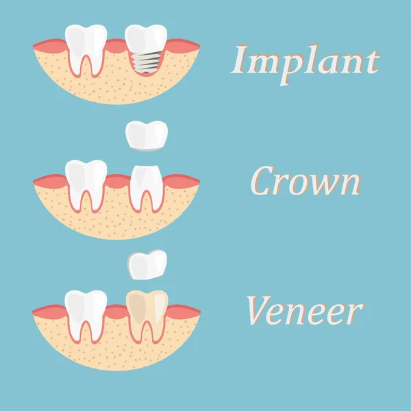 Procedura zębów implantu, korony, renowacji forniru. Proteza stomatologiczna procesowa — Wektor stockowy