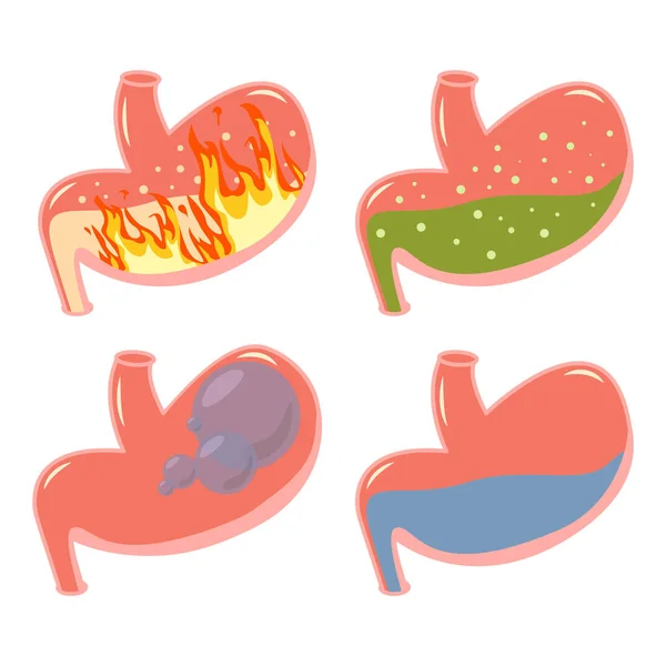 Pirosis estomacal conjunto médico. Trastorno del fuego, reflujo del ácido gástrico, bola hinchada abdominal, líquido verde — Vector de stock