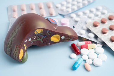 Hap tedavisi gören karaciğer modeli, siroz, karaciğer kanseri, yağlı karaciğer..