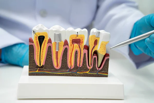 Diş implantı tutan diş hekimi, çeneye yapay diş kökleri, diş tedavisi kanal tedavisi, diş eti hastalığı, dişçi için diş modeli.