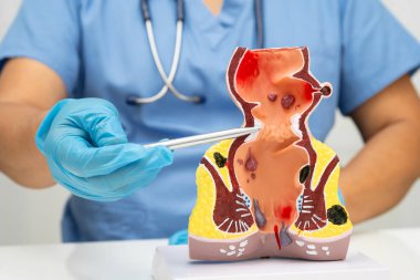 Hastanede rektum ve hemoroit insan anatomisi modeli olan Asyalı bir doktor vasküler yapısında iltihaplanma var..