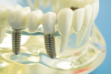 Diş implantı, çeneye yapay diş kökleri, diş tedavisinin kök kanalı, diş eti hastalığı, diş hekimliği üzerine çalışan dişçi modeli.