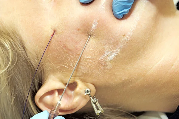 Dermatólogo Realiza Procedimiento Edad Utilizando Hilo Pdo Mujer Mediana Edad — Foto de Stock