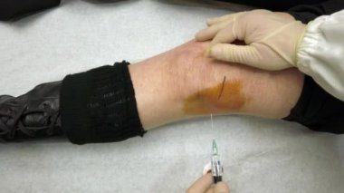 Ortopedik doktor orta yaşlı bir hastada diz kapağı ve sol bacağının menisküsüyle ilgili sorunlar için hiyalüronik asit ile uzuv sızması uygular.
