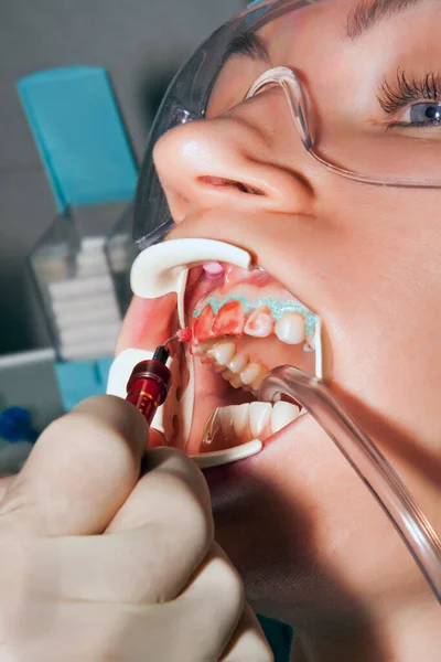 Ústní Hygiena Zubní Ordinaci Lékař Zubař Provádí Bělení Zubů Pomocí — Stock fotografie